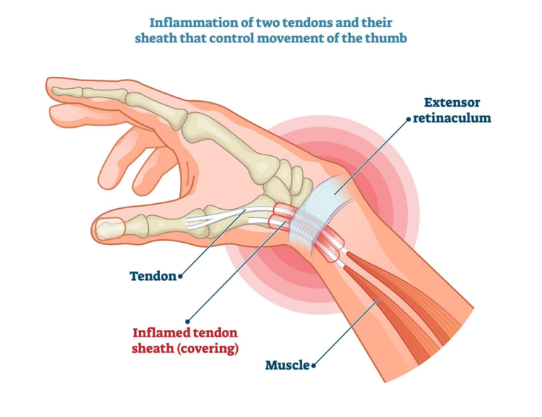 De Quervain S Tenosynovitis Complete Physio