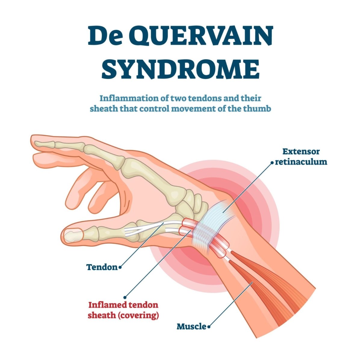 De Quervain S Tenosynovitis Complete Physio