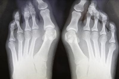 Bunion - Xray of human feet