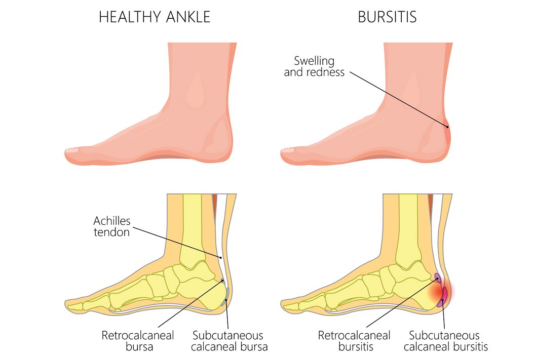 Bursitis. What is it, do I have it and what can I do about it?