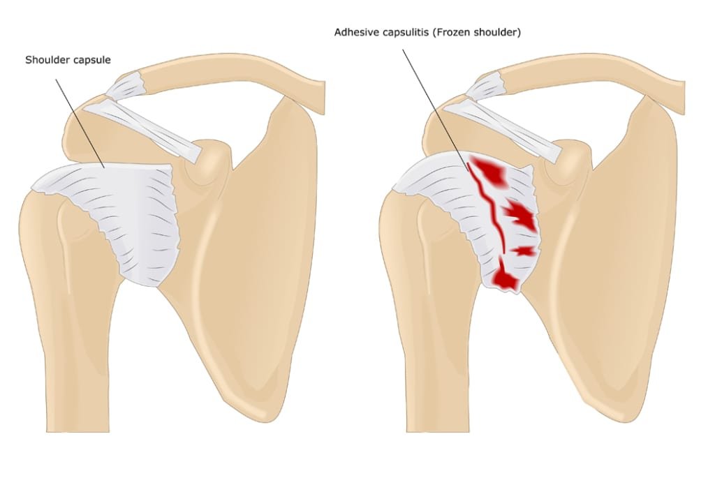 How to Sleep with a Frozen Shoulder