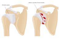 Frozen Shoulder - Do you have it? - Complete Physio