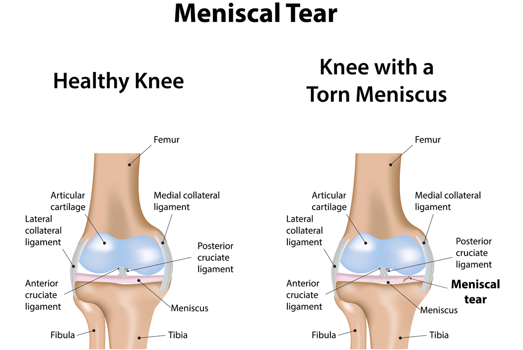 is a lateral or medial meniscus tear worse artroza diagnosticului de tratament al articulației genunchiului