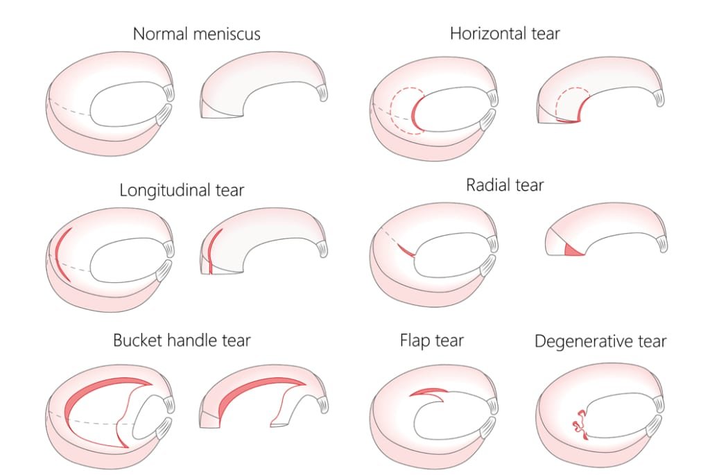 Meniscal Tear - Have You Torn Your Meniscus?