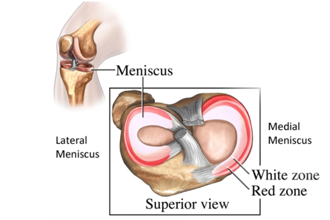 is a lateral or medial meniscus tear worse