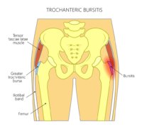 Shockwave Therapy for Greater Trochanteric Pain Syndrome (GTPS)