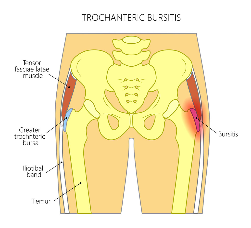 Shockwave Trochanteric Bursitis hip Complete physio London