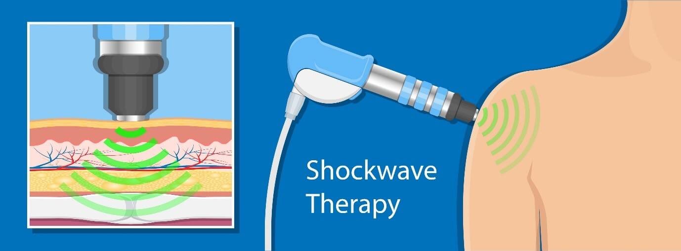 Shockwave Therapy For Calcifc Tendinopathy Tendinitis Complete Physio ...