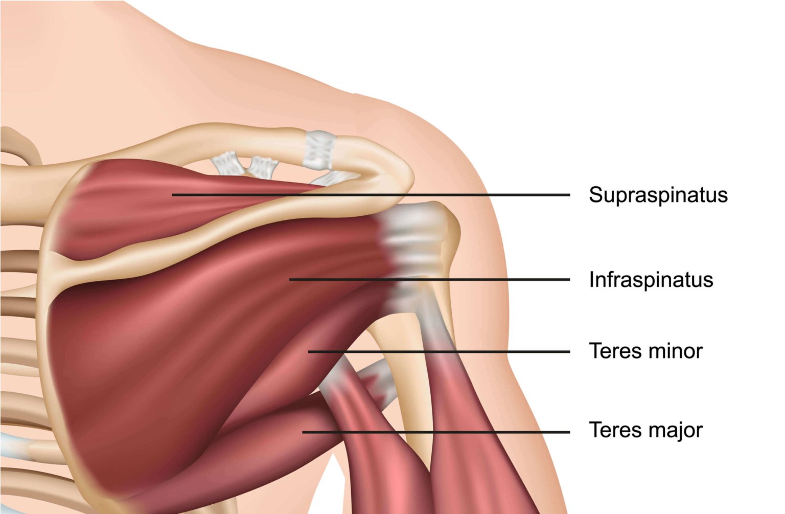 shockwave-therapy-for-calcifc-tendinopathy-tendinitis-complete-physio