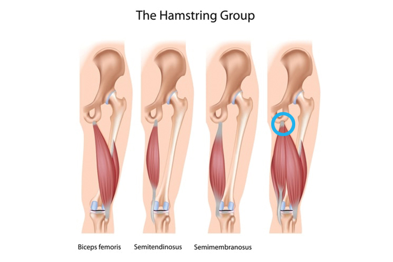 Shockwave therapy for proximal hamstring tendinopathy