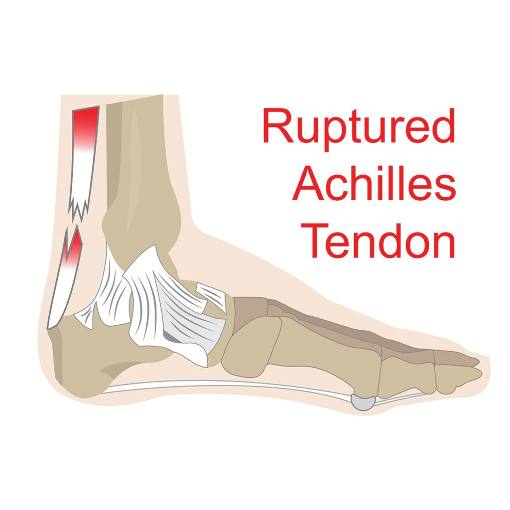 Achilles Rupture: Surgical Versus Non-surgical Treatment | Complete Physio