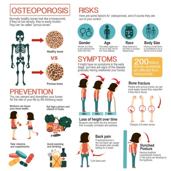 Osteoporosis | Complete Physio