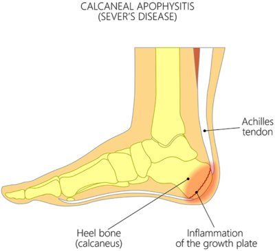 Paediatric Physiotherapy | Complete Physio