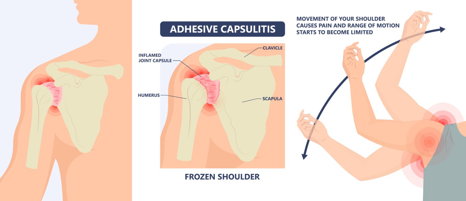 Frozen Shoulder - Adhesive Capsulitis