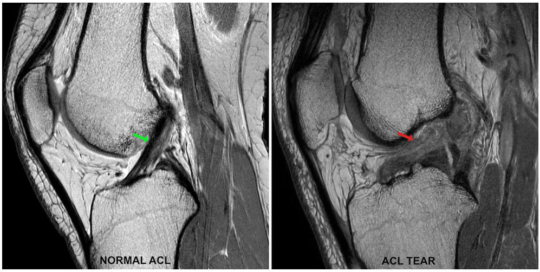 Anterior cruciate ligament (ACL) injury | Complete Physio