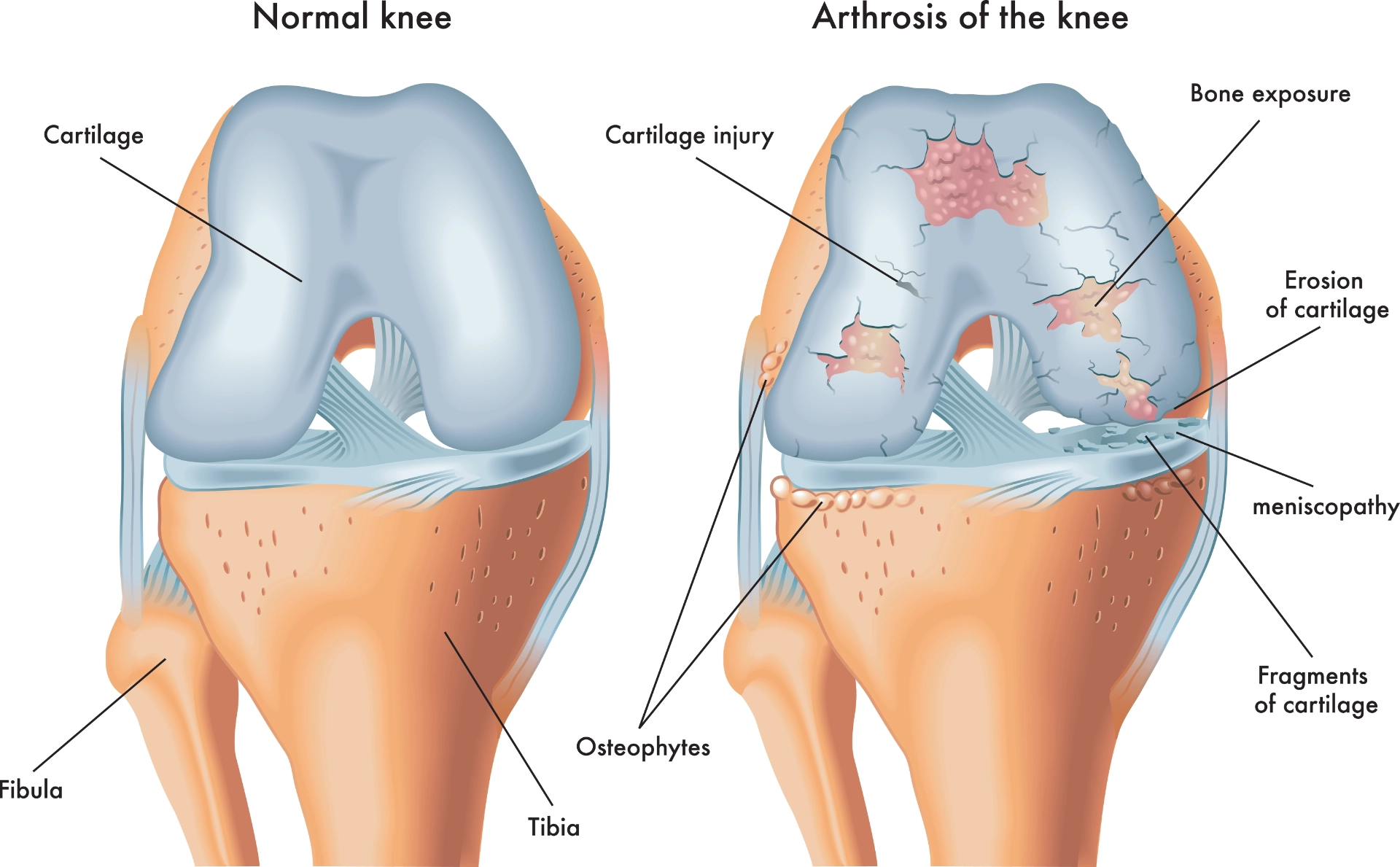 Arthrosis Of The Knee