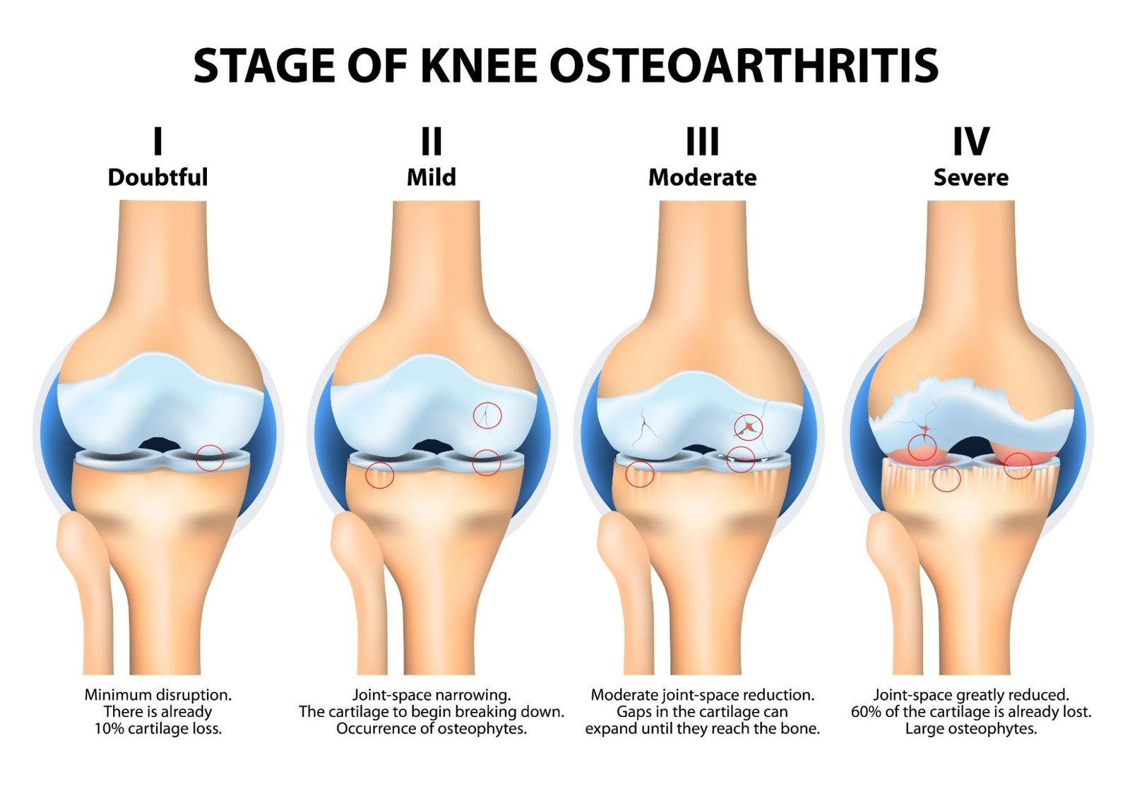 Osteoarthritis Stages Knee