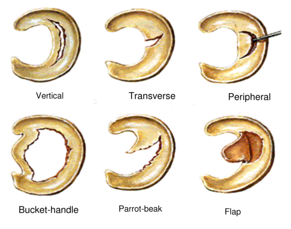 What is a meniscal tear? | Complete Physio