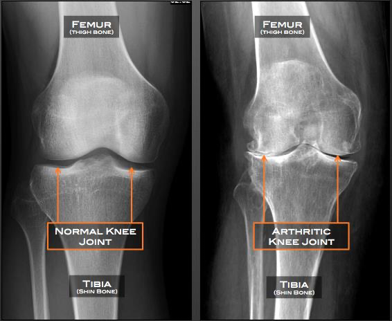 X-Ray for Knee osteoarthritis