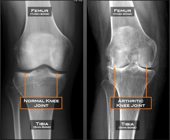 Normal vs Arthritic Knee Joint