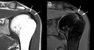 Calcific Tendinitis Of The Shoulder | Complete Physio