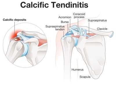 Calcific Tendinitis Of The Shoulder | Complete Physio