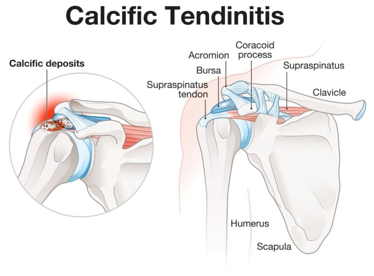 Calcific Tendinitis of the Shoulder | Complete Physio
