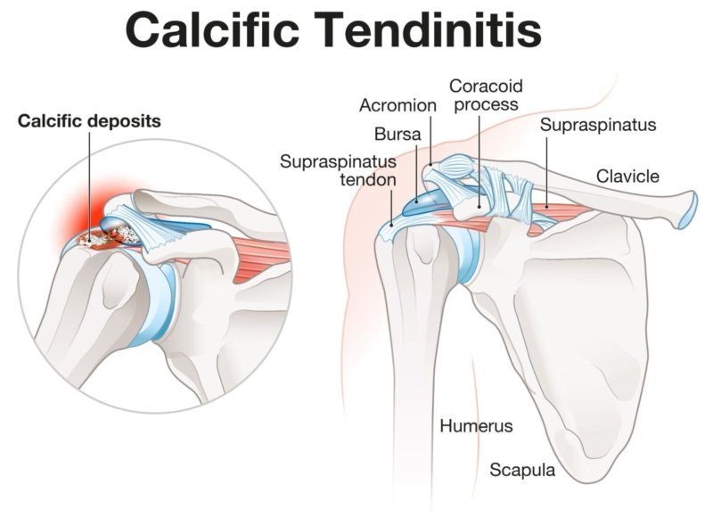 Calcific Tendinitis of the Shoulder Complete Physio