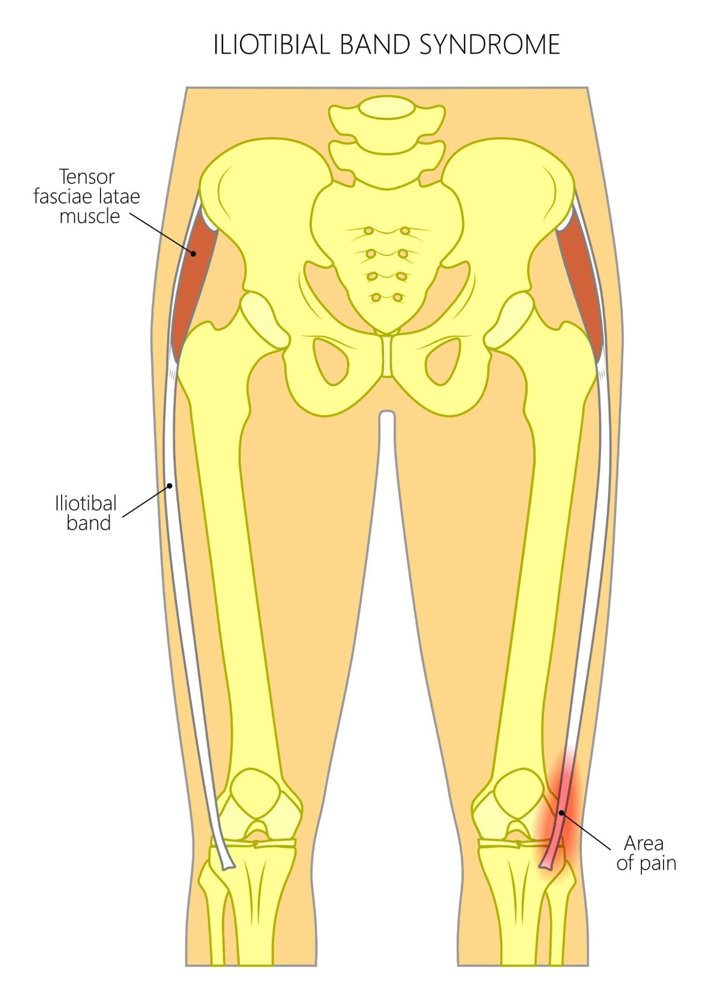 Iliotibial It Band Iliotibialband Syndrom CTOK
