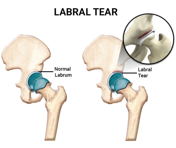 Femoroacetabular Impingement (FAI) | Complete Physio