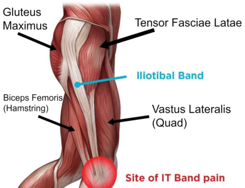 Iliotibial Band Syndrome