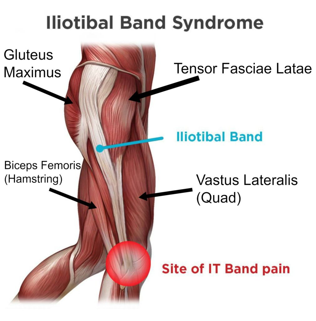 Runners Knee (also known as) ITB Syndrome - Do You Have It and How