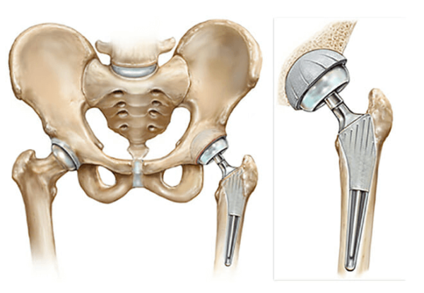 Osteoarthritis OA of the Hip | Complete Physio