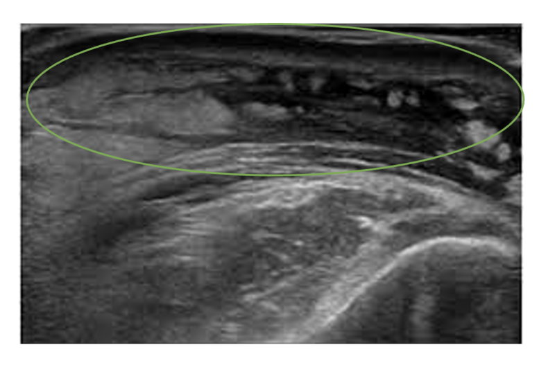 Olecranon Bursitis Complete Physio