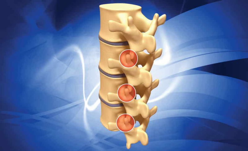 Lumbar Facet Joint Pain | Complete Physio