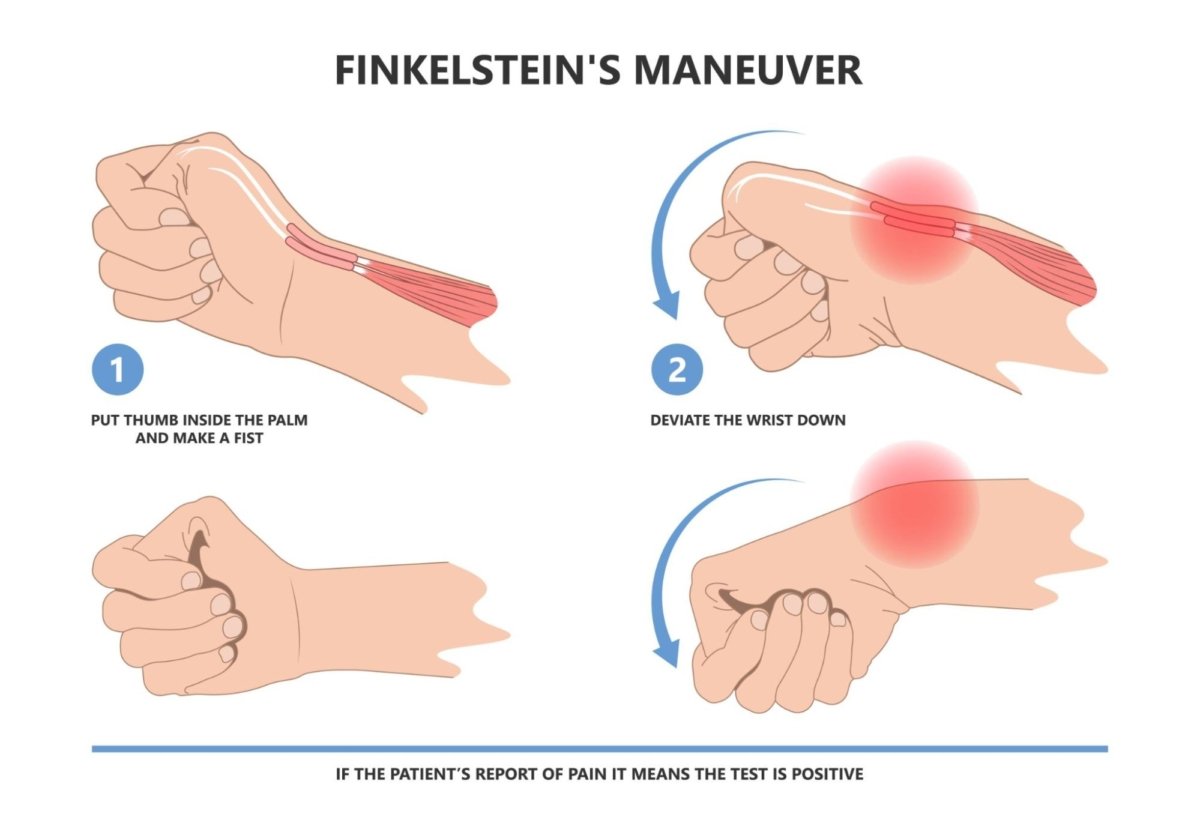 De Quervains Tenosynovitis Complete Physio 6800