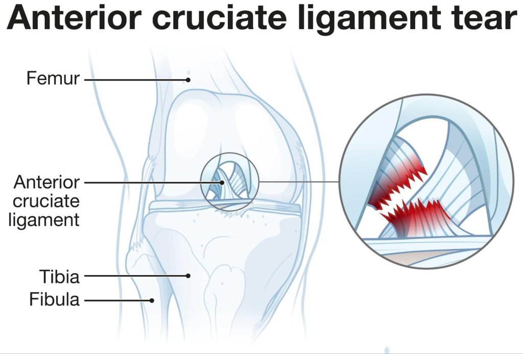 Anterior Cruciate Ligament Rear