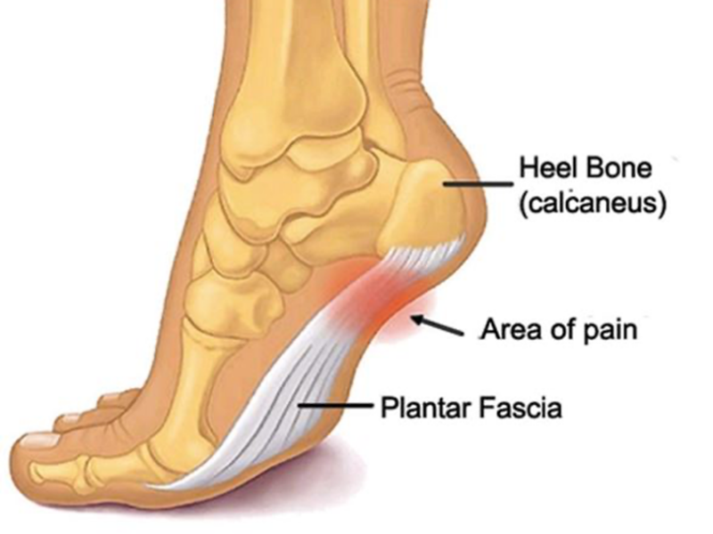 Heel Pain - Plantar Fasciitis | Complete Physio