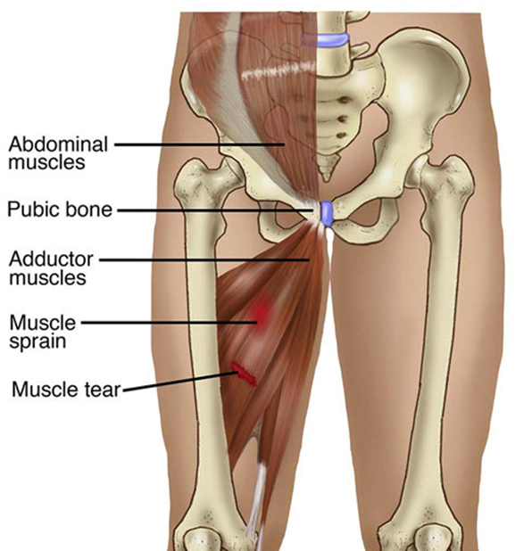 Pectineo-femoral pinch syndrome: A common cause of groin & anterior thigh  pain and weakness - MSK Neurology