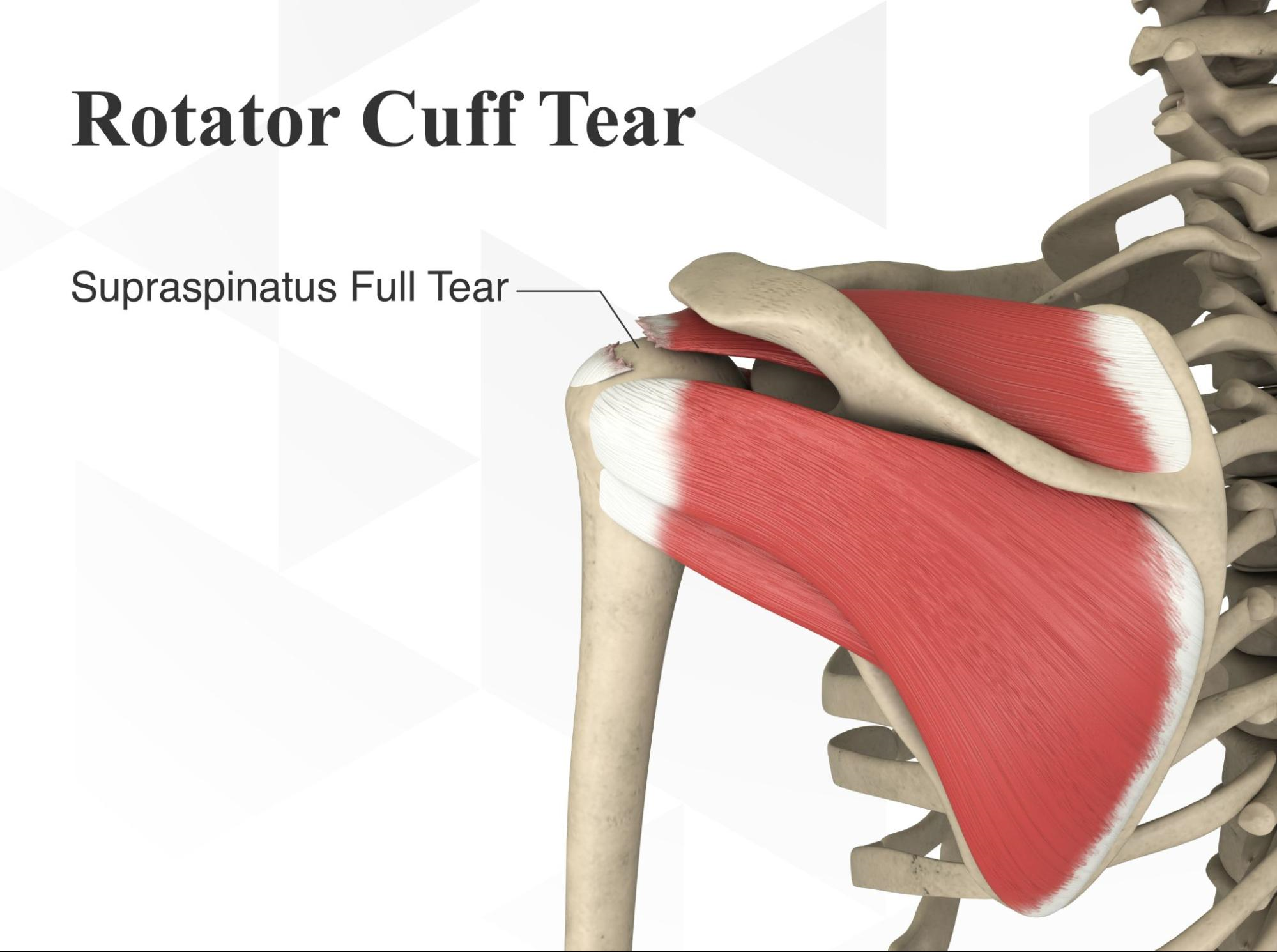 Rotator Cuff Tear  What Is It, Symptoms & Treatments