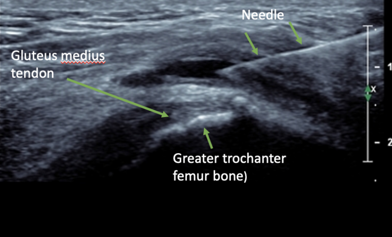 Greater Trochanteric Pain Syndrome - GTPS (also Known As Trochanteric ...