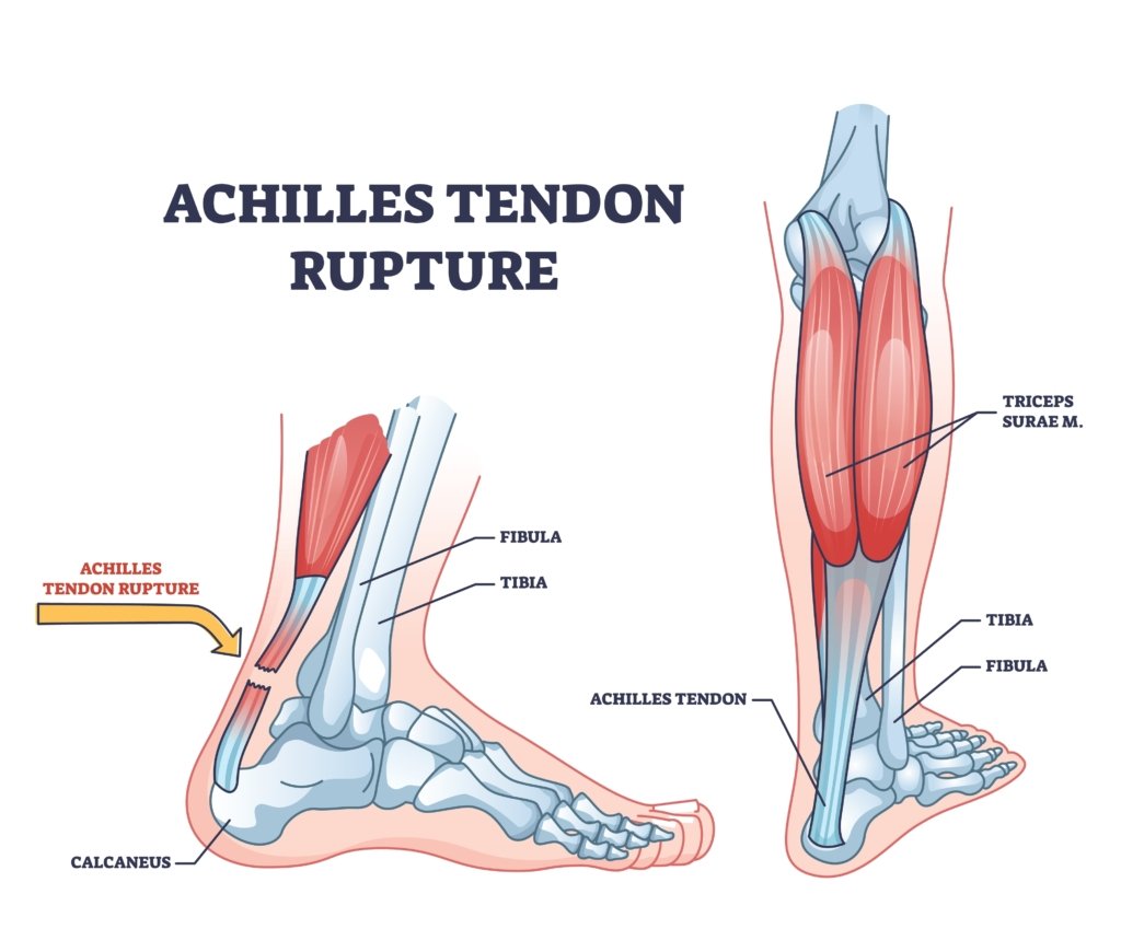 Achilles Tendon Rupture