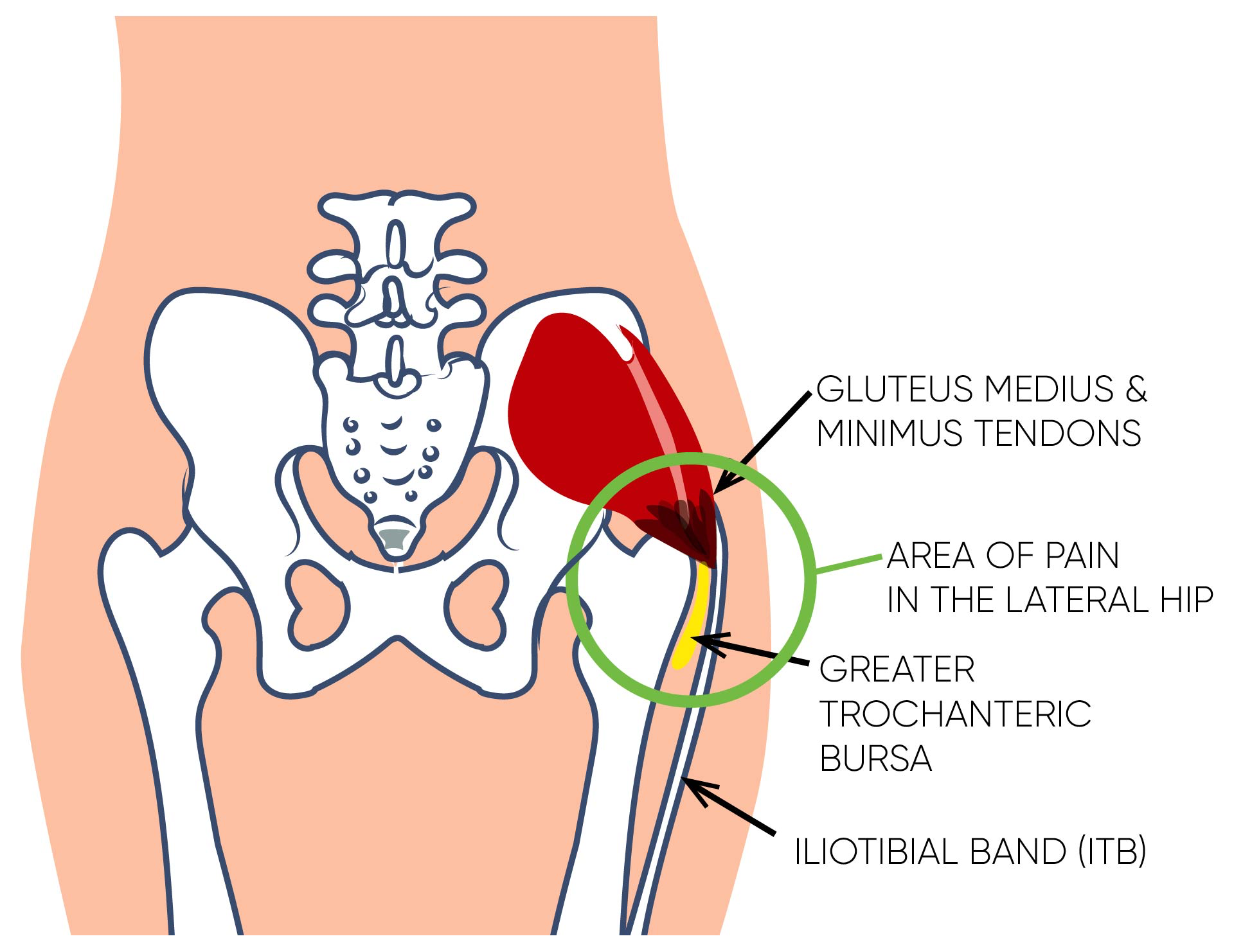 Normal anatomy of the lateral hip region. The gluteus medius