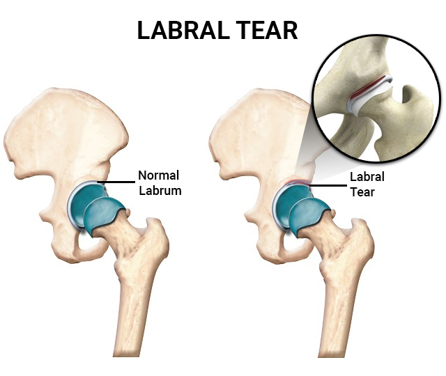 femoroacetabular-impingement-07