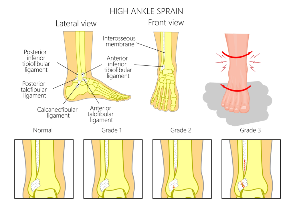 A High Ankle Sprain injury