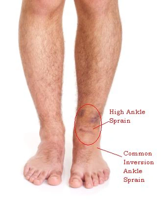 High Ankle Sprains