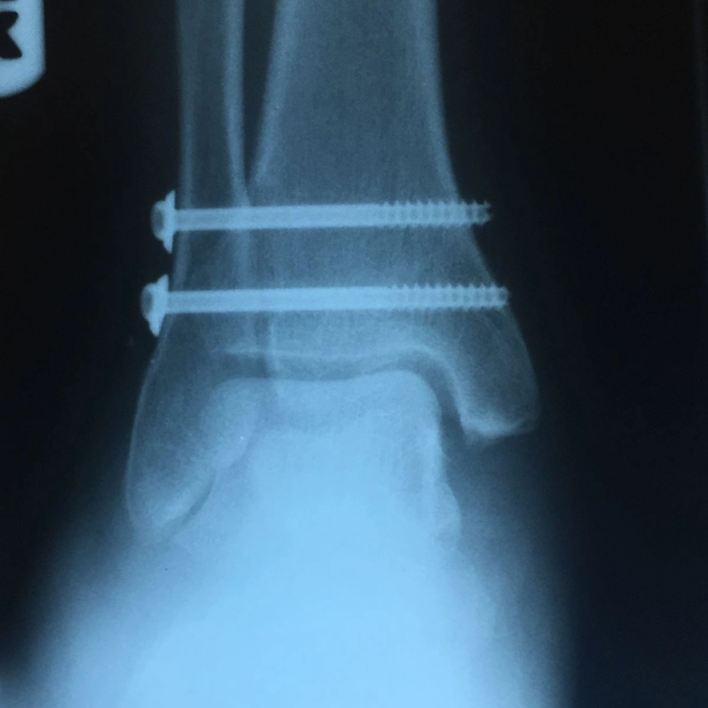 High Ankle Sprain Surgery