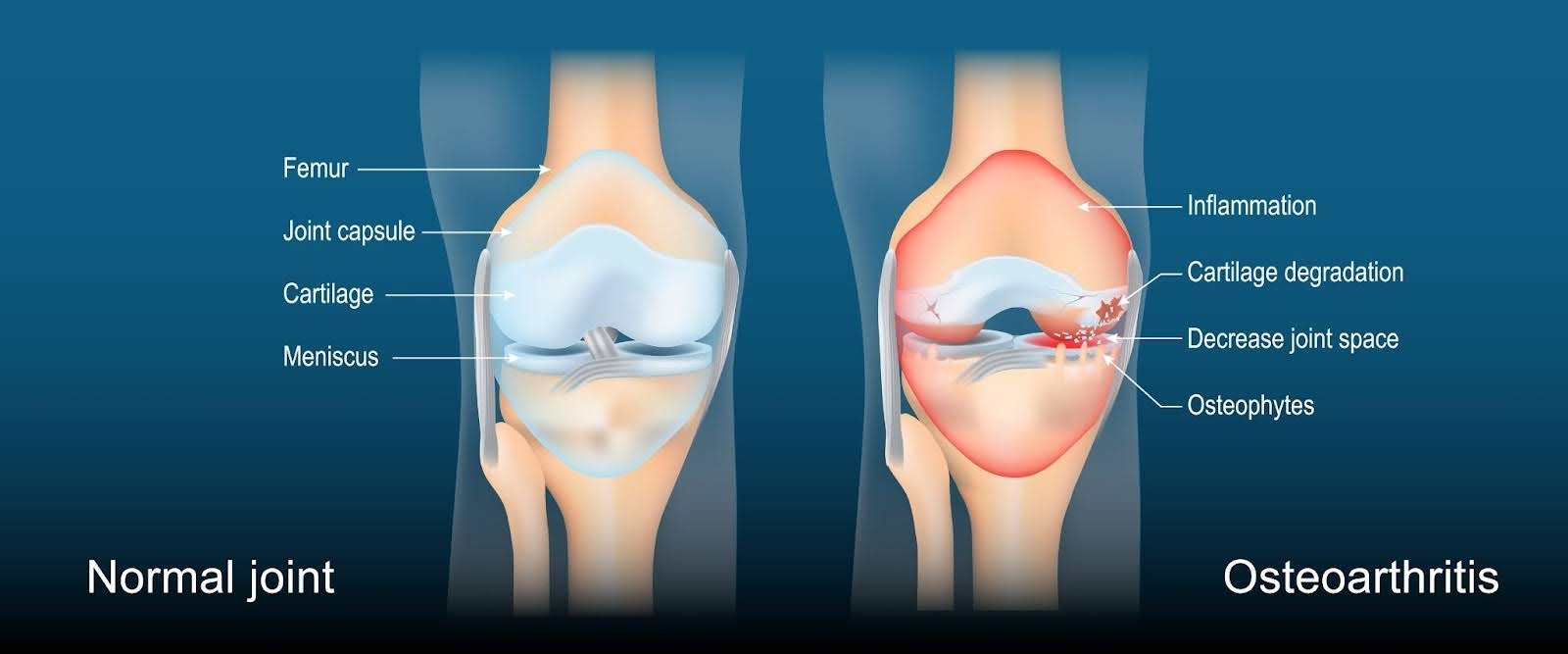 Normal Knee Joint versus Osteoarthritis