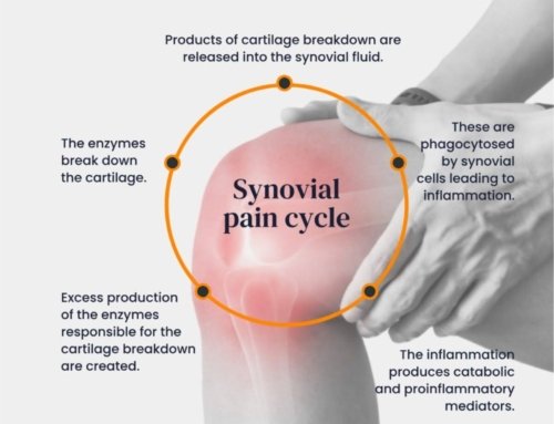 Arthrosamid Injections for Knee Osteoarthritis