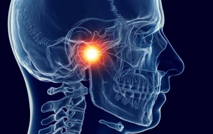 TMJ Disorder